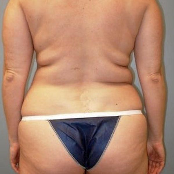 Before liposuction