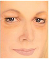 Illustration of candidate for Eyelid Surgery